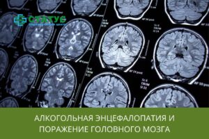 Алкогольная энцефалопатия и поражение головного мозга