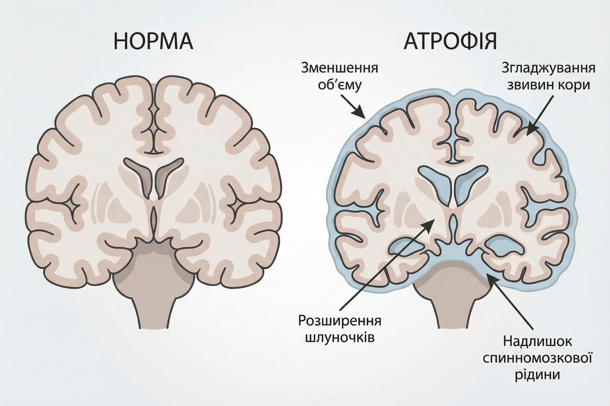 Наслідки енцефалопатії