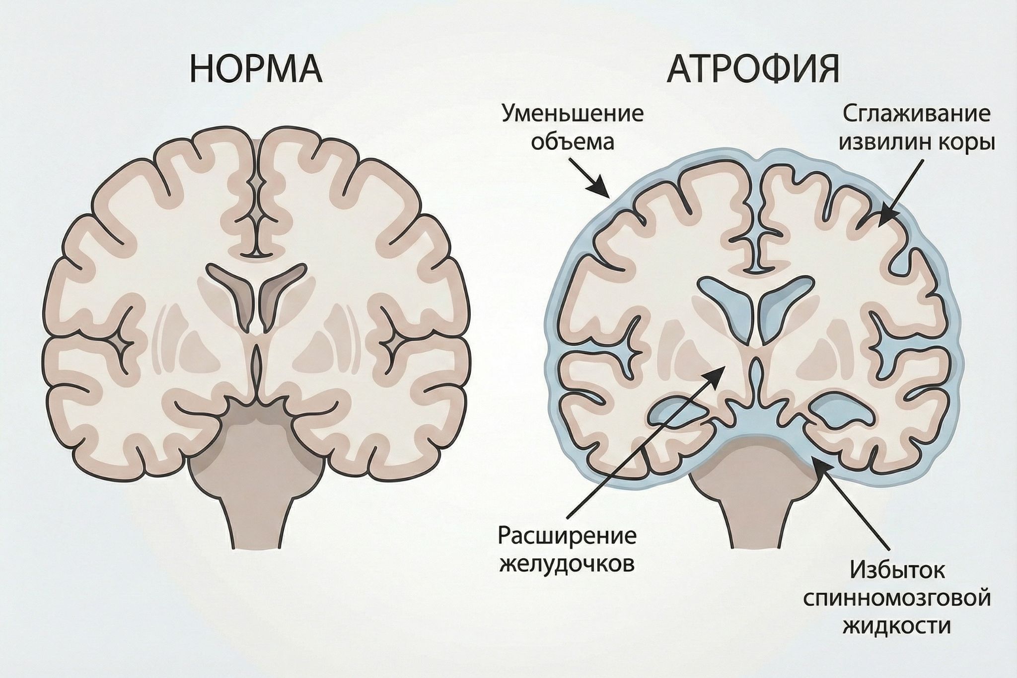 Последствия энцефалопатии